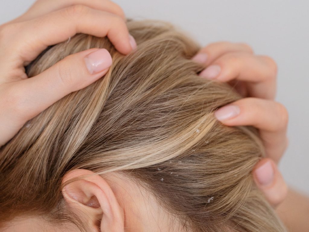 Mãos acariciando cabelo com caspa visível
