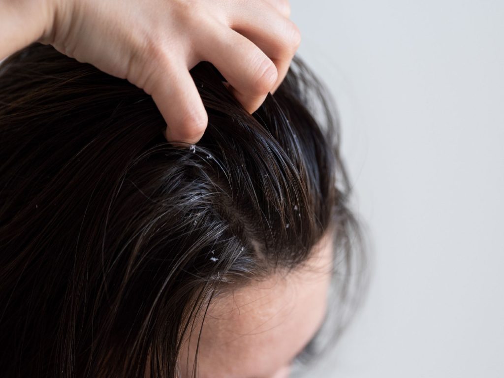 Pessoa coçando o couro cabeludo com caspa visível.