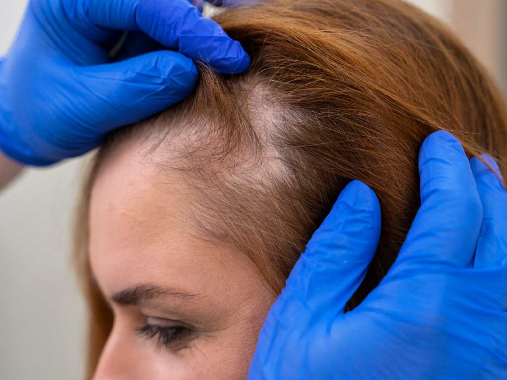 Avaliação de queda de cabelo em paciente