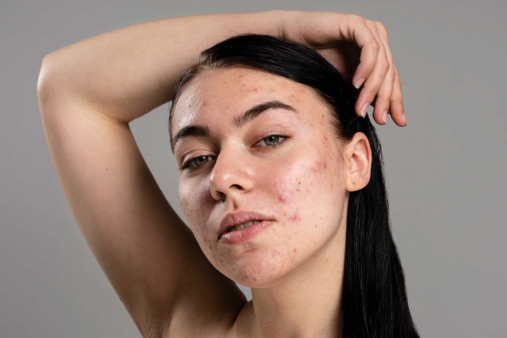 Modelo de pele com acne posando para a câmera
