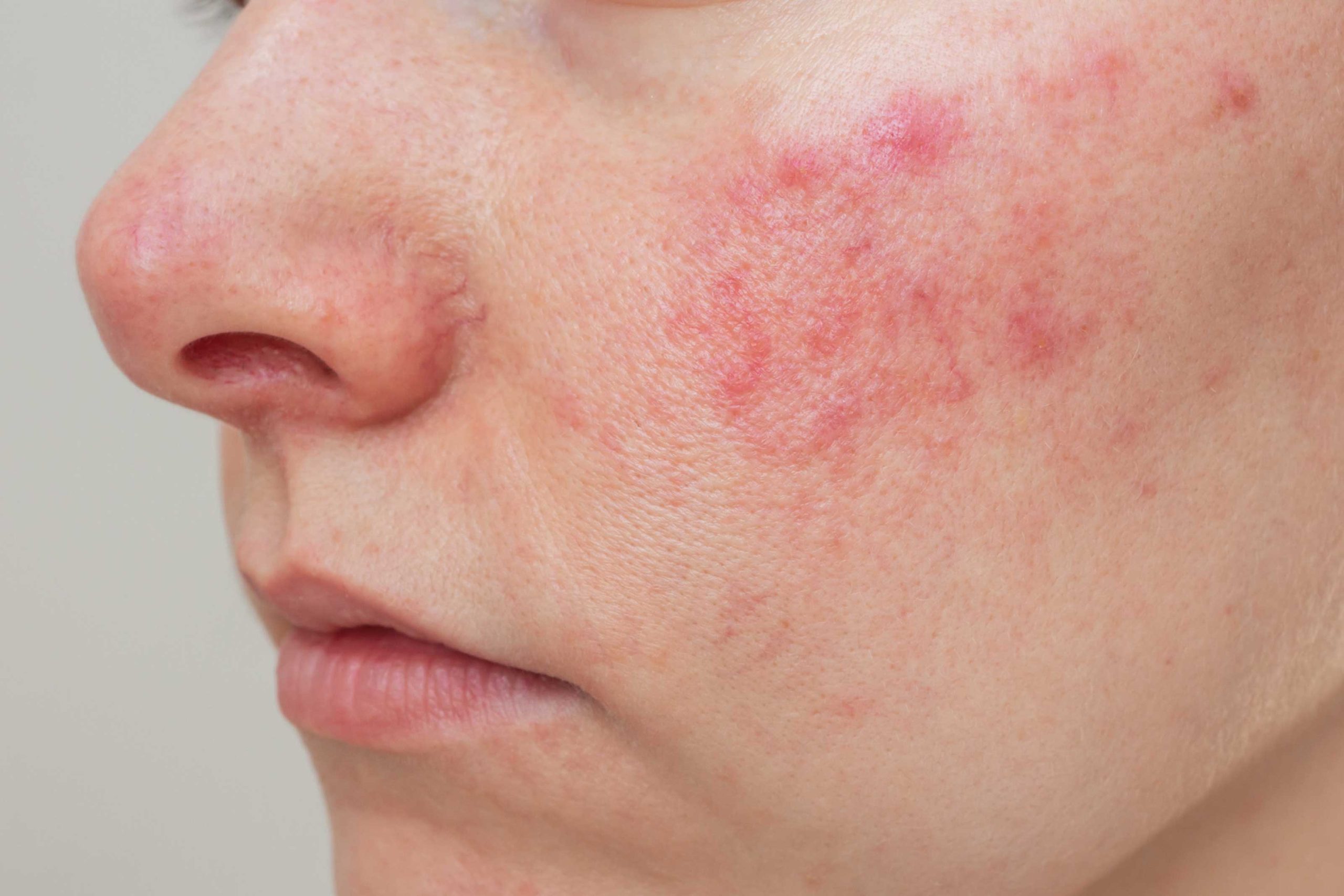Pele com acne e vermelhidão no rosto