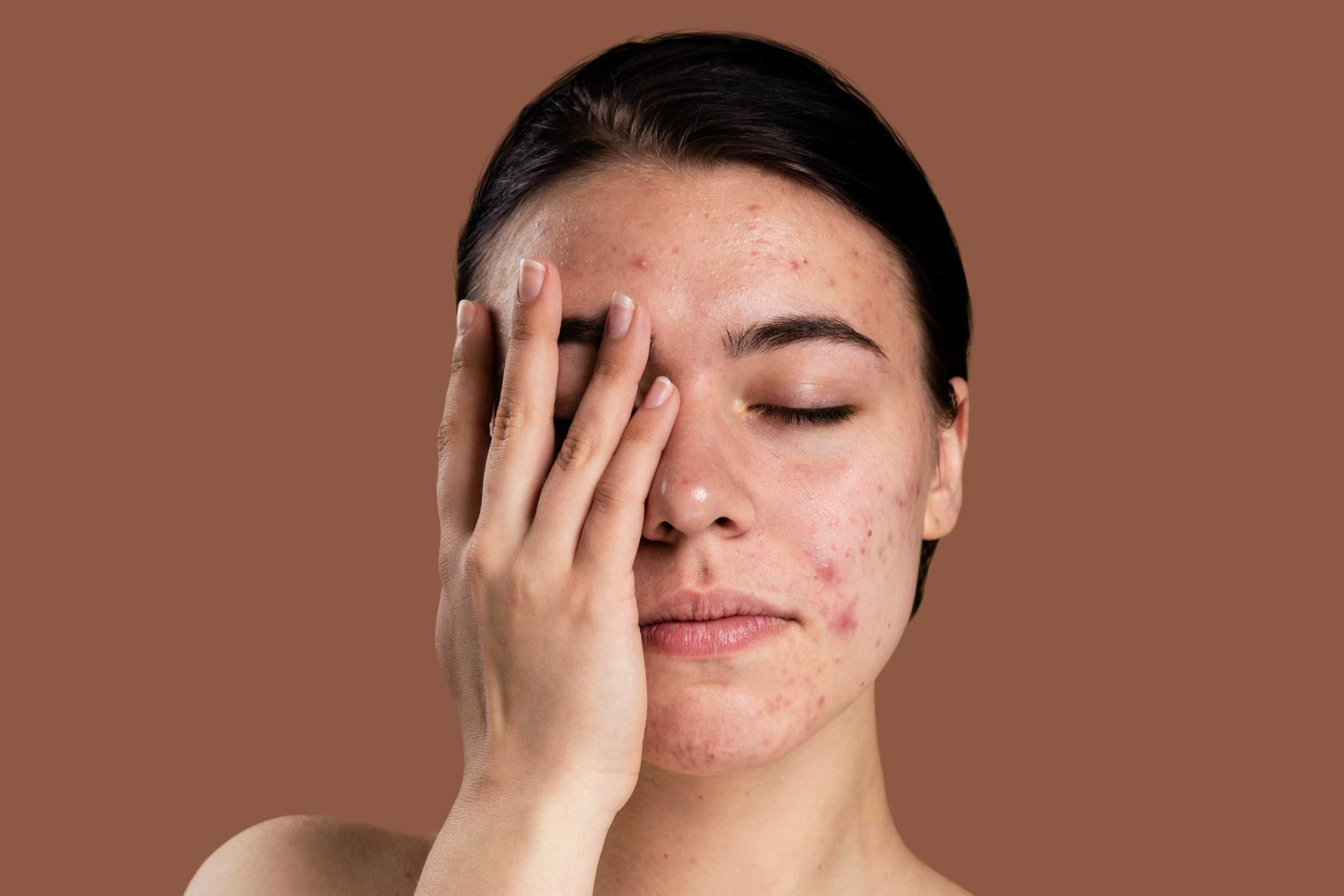 Mulher com acne cobrindo o rosto com a mão