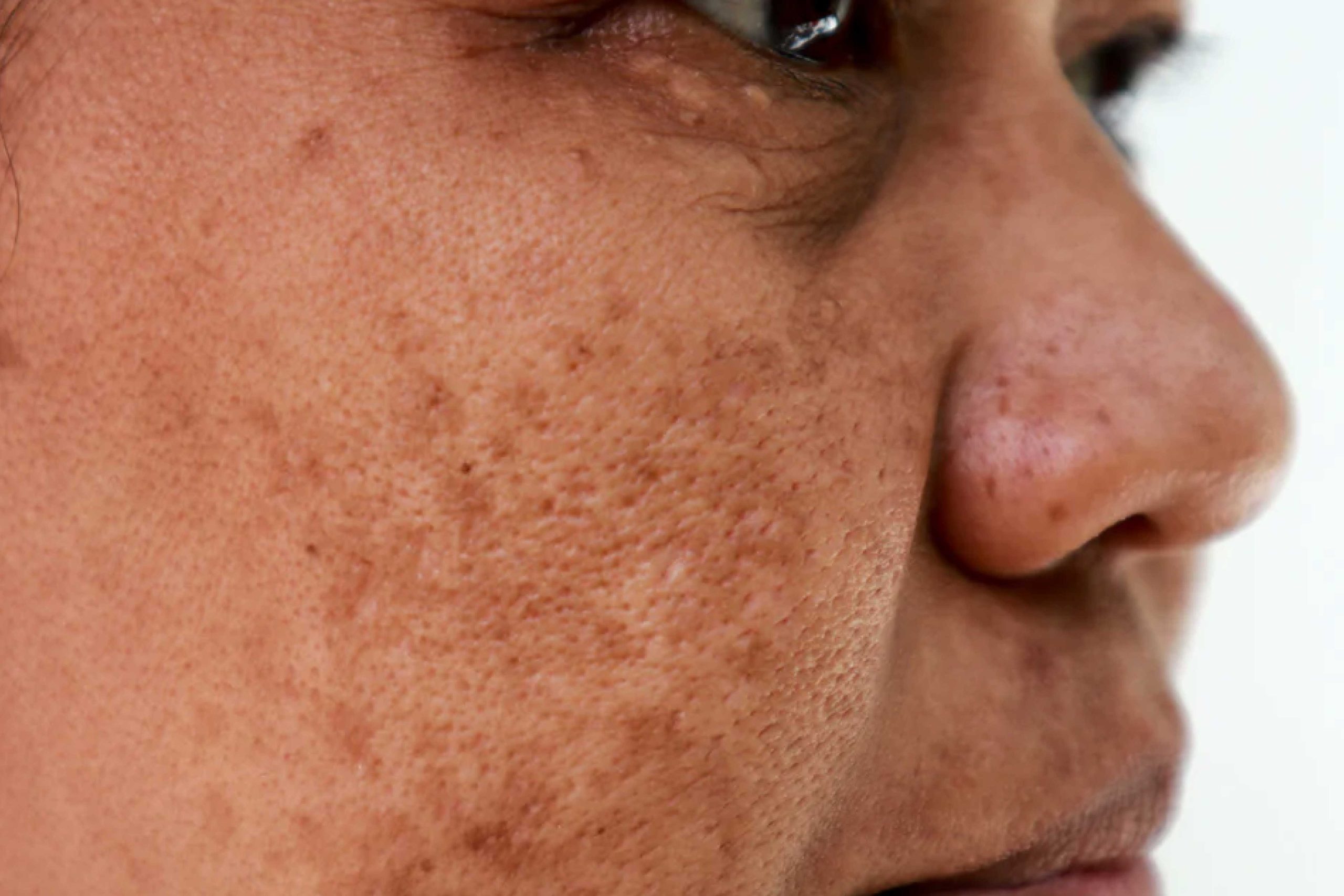 14e66671_imagem_blog_1_mulher_melasma.jpg