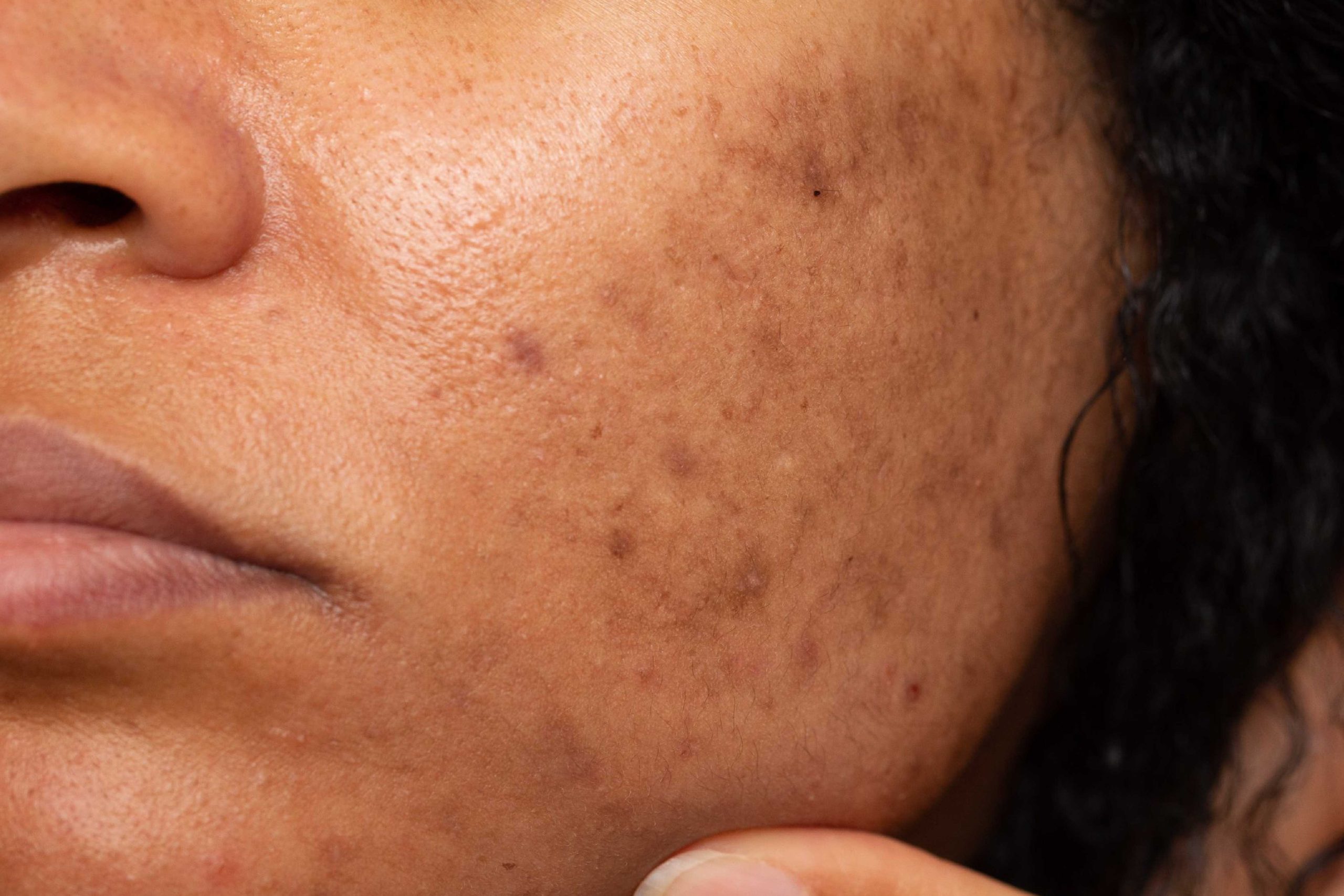close-up de pele com manchas e acne