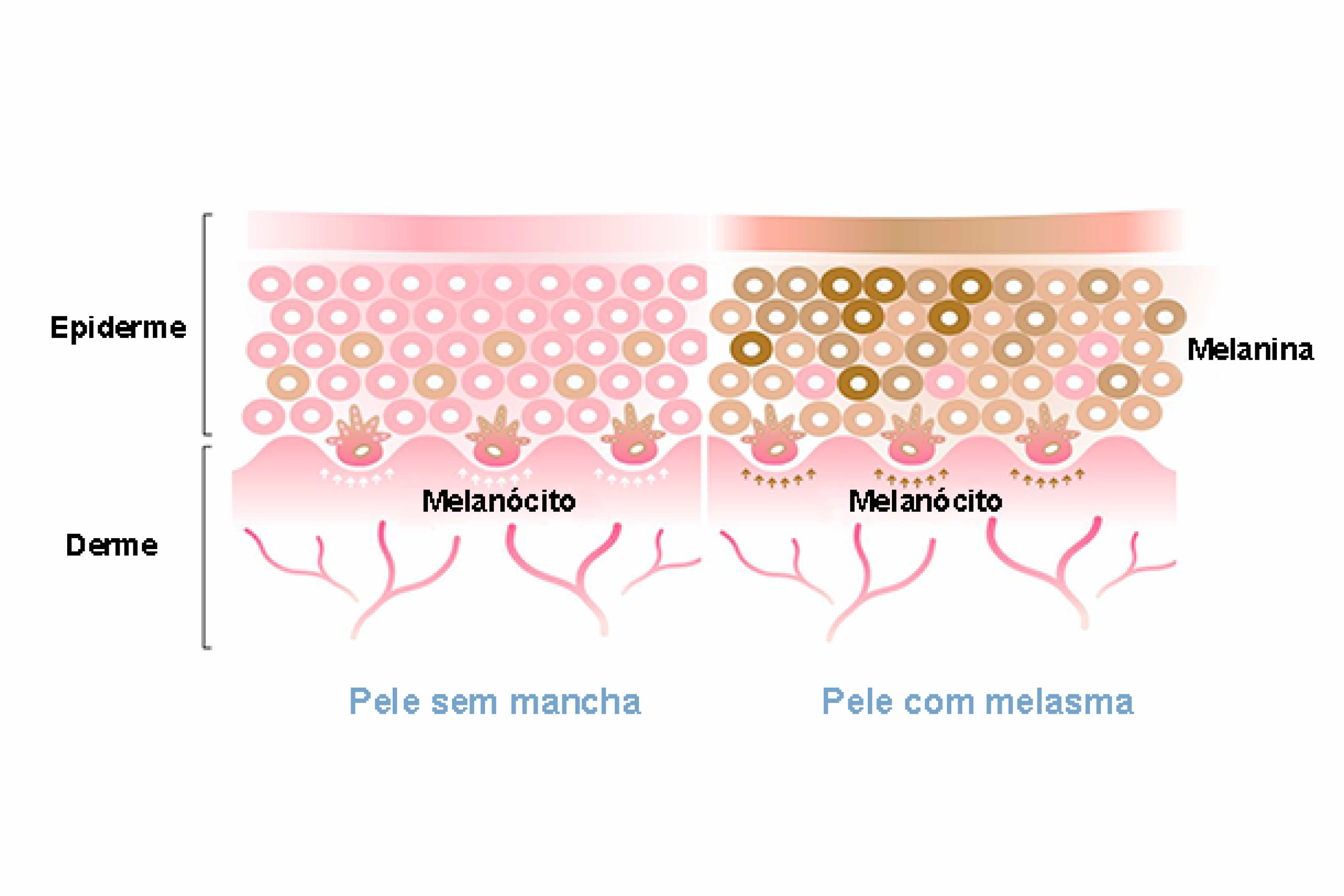 Comparação da pele sem mancha e com melasma