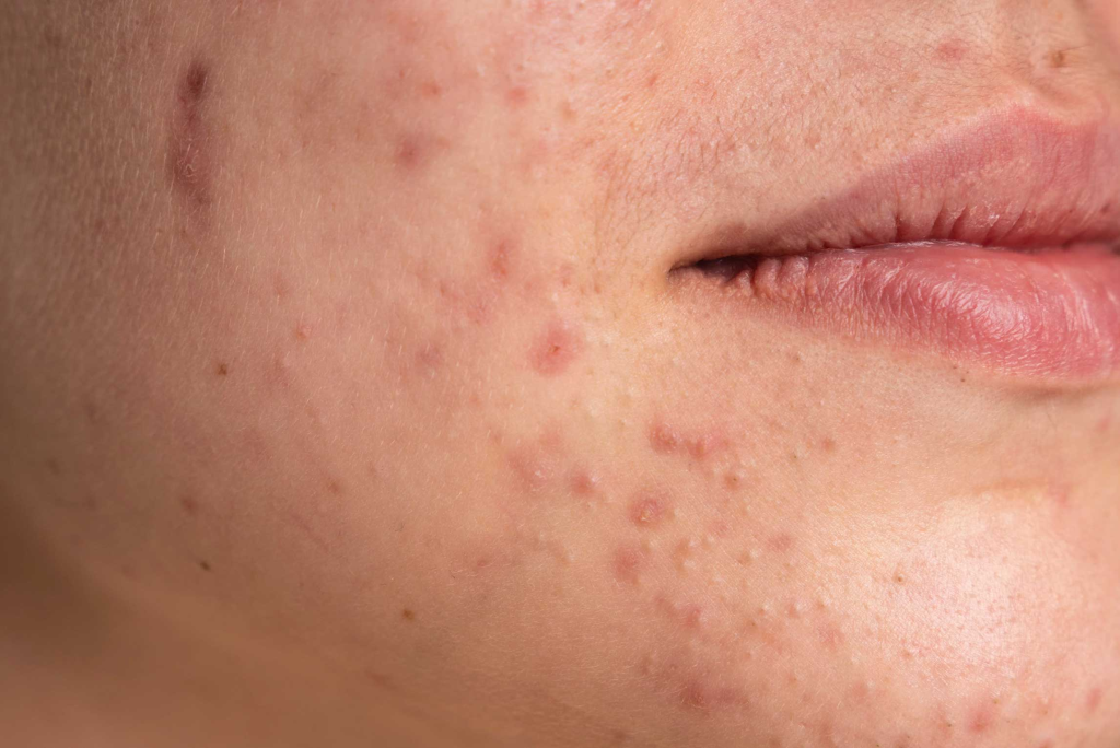 imagem_blog_3_mulher_acne