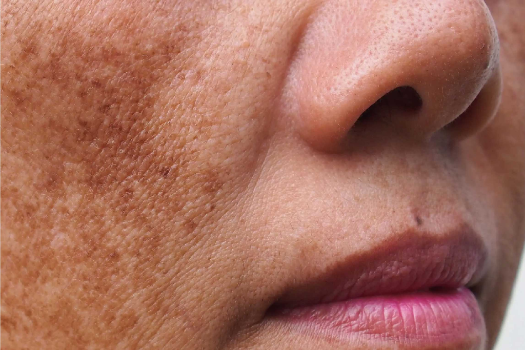 imagem_blog_4_mulher_melasma