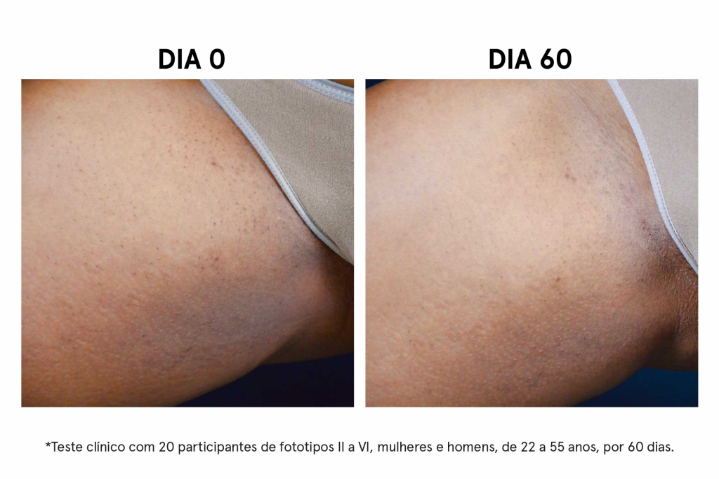 imagem_blog_5_resultados_virilha