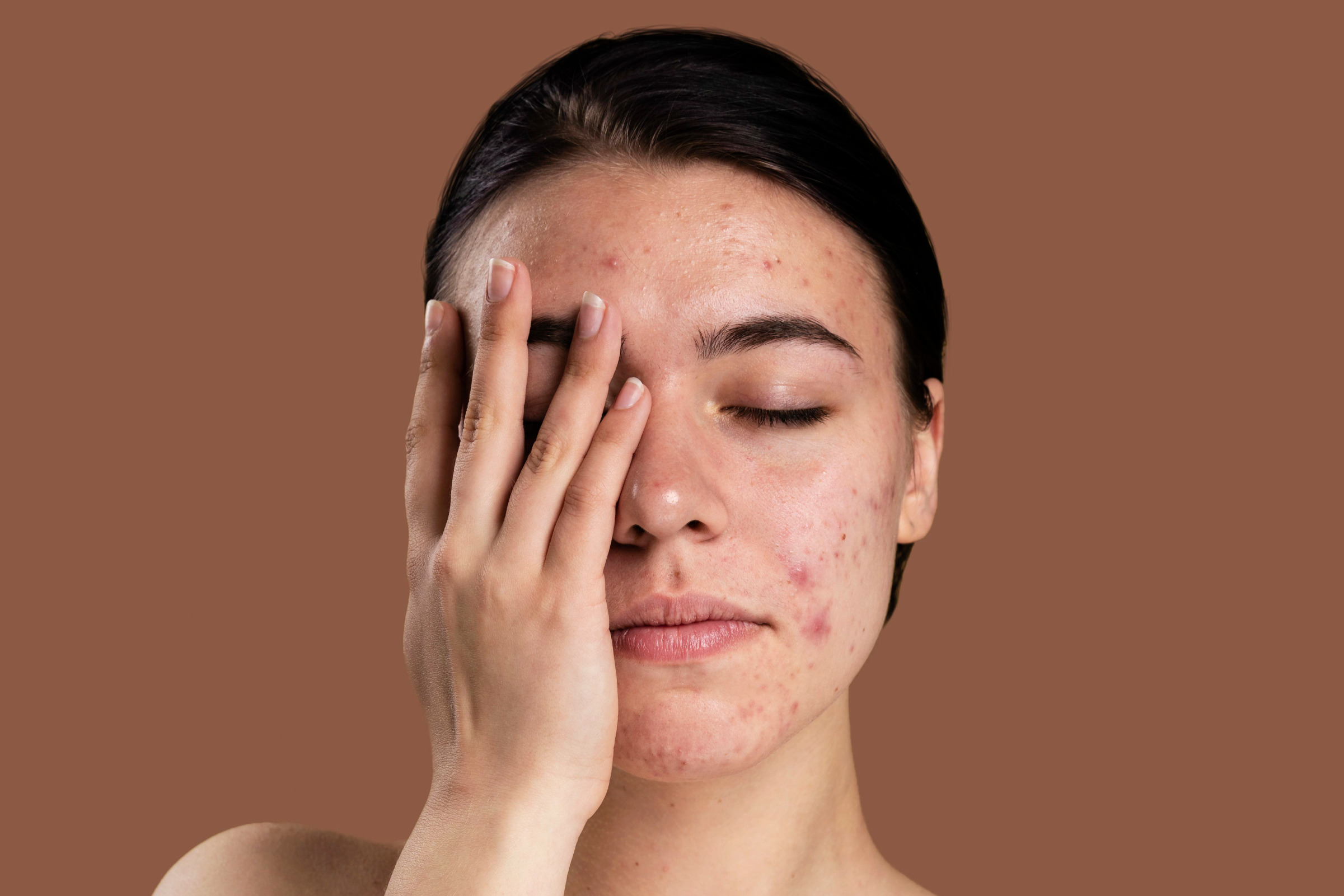 20b5b6f7_imagem_blog_3_pele_acne.png